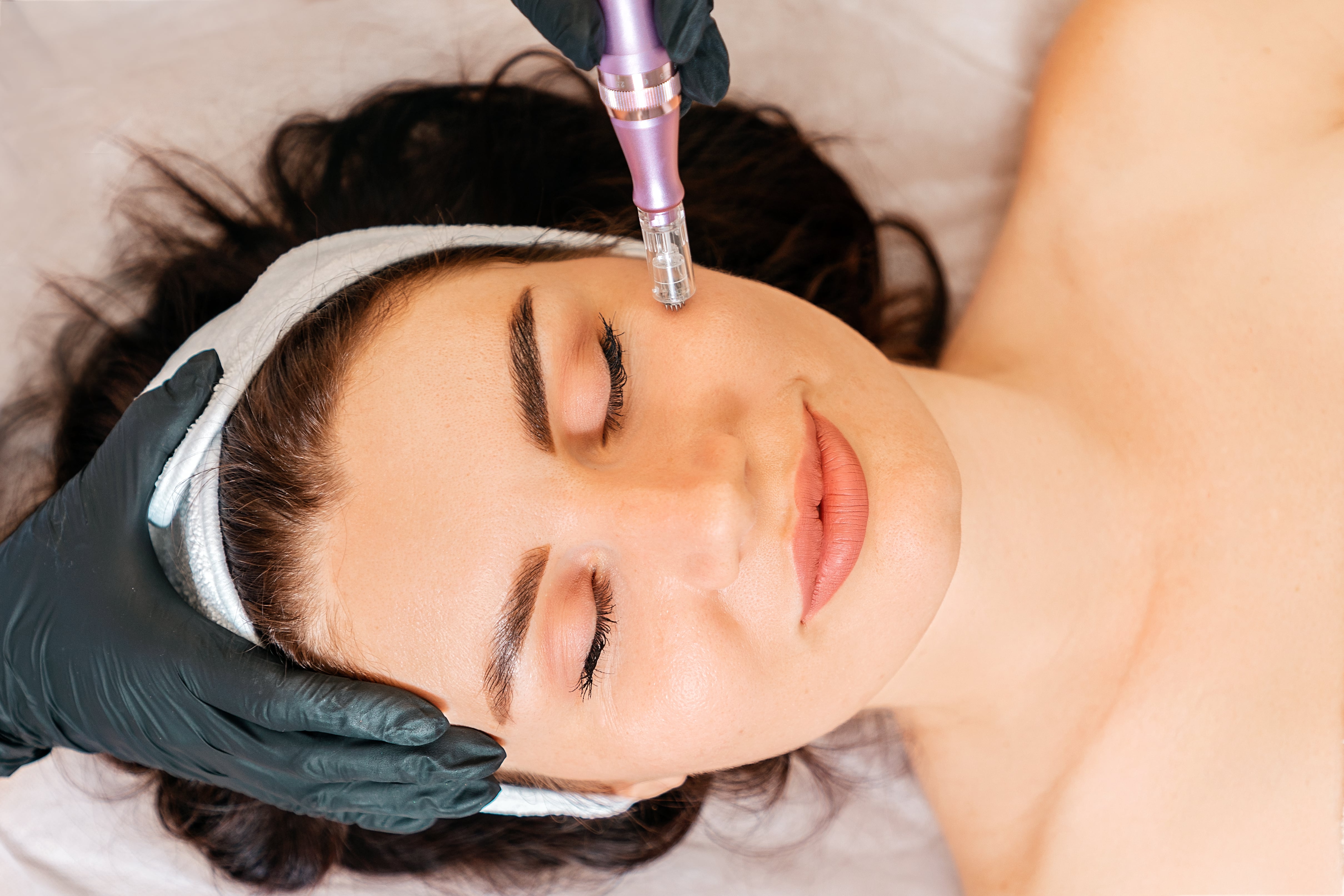 Microneedling At Atelier Aesthetics